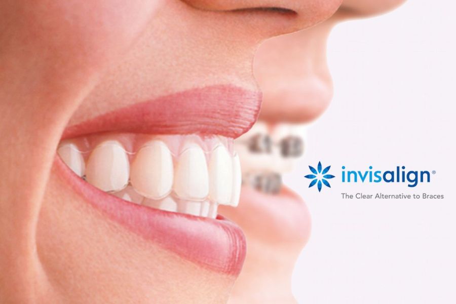 Invisalign 