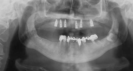 Tandheelkundig implantaat